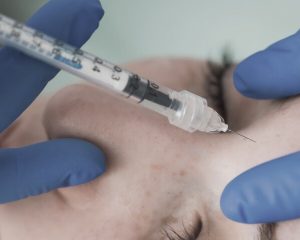 A picture of a bruise, showing skin discoloration.