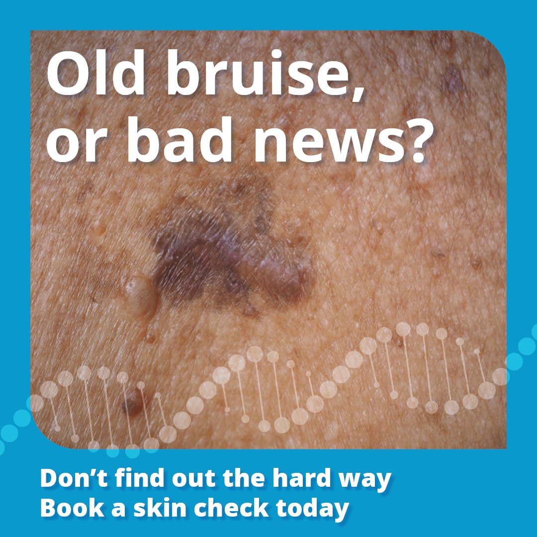 Image of a bruise