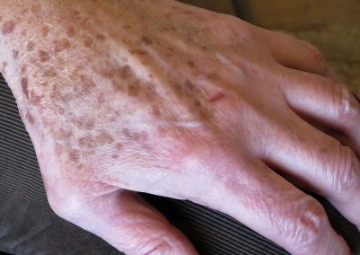 Image of Lentigo senile