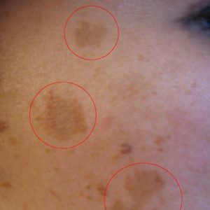 Blemish image