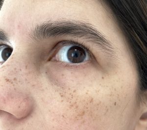 Freckle after summertime