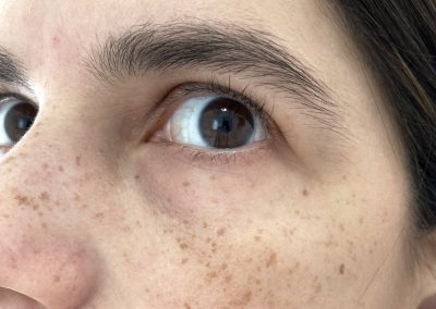 Freckle after summertime