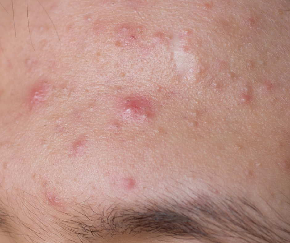 Facebook Posts-Karrinyup Dermatology